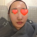 [영등포 피부과] 미소미의원 여드름치료 솔직후기 (효과, 소요시간)