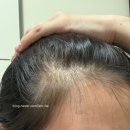 다시온의원 | 20대 여자 탈모 모즈의원 줄기세포 두피 영양주사(PDRN) 혈장 PPP 스킨 테라피 받은 일주일 후기