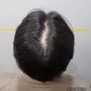 채움남성의원 | 압구정 두피문신 후기, 안전한 반영구 맞춤형 시술 리앤채움에서