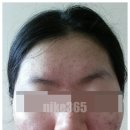 보고봄 | 아그네스 레이저 내돈내산 후기 받아보고 솔직하게 적어봄