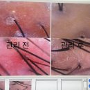 출산후 탈모에 대구두피관리 샵 멋진인생 에스테틱 두피센터 황금점