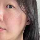 디오피부과의원 | 디오디피부과 청담 스컬트라 후기 (눈밑꺼짐,팔자주름,옆볼패임)