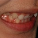 옹니와 웃을 때 잇몸이 많이 보이는 치아가 걱정되신다면? 이미지