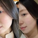 맑은빛피부과의원 | 강남구청피부과, 줄기세포 스킨부스터 효과 및 솔직후기 (이노벨의원)