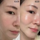 창원1 | 창원 피부과 리쥬란힐러 1회차 / 엠보 / 통증 / 솔직후기
