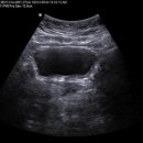 ovary huge cystic lesion 이미지