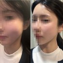 엘레브의원 | 엘레브의원 티타늄리프팅 관리 후기