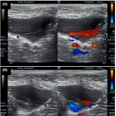 개의 정상 ureteral jet의 morphology와 초음파 상 ureteral jet 식별의 최적화 방법 이미지