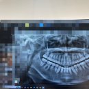 서울온샘치과의원 | 강남 화이트드림치과 교정 유지관리 턱관절 치료