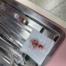 신세계미치과의원 | [춘천/사랑니 발치] 미치과 후기