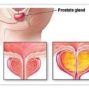 전립선염 아닐까? - 전립선염 증상의 원인과 치료 이미지