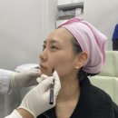 제이디의원 | 강남제이디의원 - 나노실리프팅+프롤로인대리프팅주사 일주일 후기