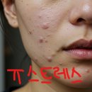 디박스카케어 | 흉터 색소침착 연고 500만원 써본 결론