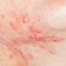 닥터셀케이 | 부산 턱모낭염 턱여드름 구분 및 항생제 치료 차이점 (압출 가능 여부)