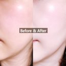 AB성형외과에서 개발한 엑소좀스킨부스터 에이버화장품 엑소좀 크림 사용 후기