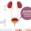 여자 방광염 증상 발생 반복되는 원인 막는 팁 이미지