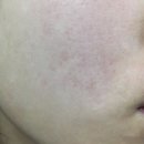 나은약국 | 고딩 여드름쟁이 딸 아클레어클렌징폼 쓰고 나은 후기