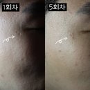 미소로한의원 | 수원 인계동 얼굴 여드름, 패인 흉터 오름테라피 받은 후기 (치료기록 5차)
