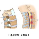 후종인대 골화증 이미지