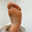 신림 다비드래쉬 발각질 케어 만족 후기