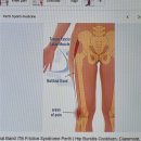 보험개발원 | 러닝 후 무릎 바깥쪽이 아프다면? 절뚝거리다 장경인대증후군 진단받은 후기