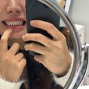 스마일라인치과기공소 | 강남 라미네이트 연예인 치과 솔직한 상담 후기, 교정고민