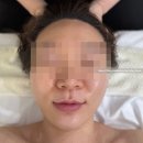리트랜디 | 일산피부관리 MTS연어관리 리글로우에스테틱 후기