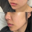 카프리 | [대구 동성로피부과|대구피부과 추천]카프리레이저 후기 효과