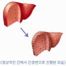 술 좋아하고 뚱뚱하면 `간`은 이 모양 이 꼴! 이미지