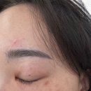 세븐일레븐광주수완신완점 | 광주비립종제거 아온 후기