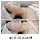 군산 비대칭관리 수송동 벨라리니아에스테틱 웨딩윤곽관리 솔직후기