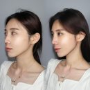 달미코코 | 홍대 코실리프팅 폼미코로 매부리 교정한 전후 비교 찐 내 돈 내산 후기