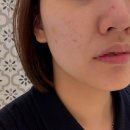 청담안즈피부과의원 | 강남 안즈피부과 쥬베룩 일반 시술 후기 ✨