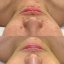코아종합화장품 | 여드름 흉터, 3회만에 이렇게 바뀝니다 /라라라뷰티
