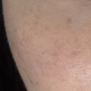 차한의원 | 기미잡티 3D 맞춤토닝 5-7회차 후기 | 구로 끗 한의원 듀얼토닝 제네시스 딱지레이저