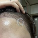 <모발이식> 비절개 3500모 POD 1일차 ~ 7일차 완전 상세한 리얼 후기!!(3)