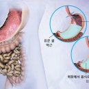 위마비 라고도 합니다.: 위배출 지연 이미지