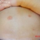 강남동약한의원 | 건선치료후기 : 화폐상건선 __ [강남동약한의원 · 건선치료후기]