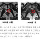 한달만에 암 사라져, 주변 장기 피해 '0'…3000억 들인 '꿈의 치료기' 성공 이미지