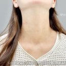 이정헌피부과의원 | 얼굴 사마귀 제거 시술후기 입니다~