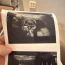 양수강남의원 | 노산 임신 12주 목투명대 3.7mm판정, 융모막 검사 결정한 이유 (서초함춘여성의원, 함춘익스프레스)