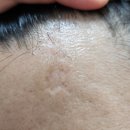 리성형외과의원 | 이마 대상포진 흉터 치료 후기 – 수원 리성형외과에서 흉터 관리받고 있습니다!
