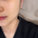K메디칼 | 대구신암동 윤곽피부관리 알테온V리프팅 끌라르떼에스테틱 2회차 방문 찐후기! 확실히 달라진 윤곽 라인