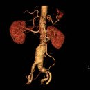 ﻿복부 대동맥류는 뱃속 시한폭탄﻿ 이미지
