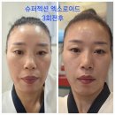 MS | 대구동천동MS 에스테틱 슈퍼젝션 엑소로이드 앰플사용후기