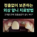마이덴치과의원 | 부러진 앞니, 임플란트 없이 재신경치료로 살린 후기| 종로 치과