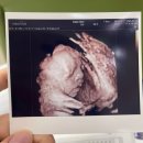 다나한방병원 | [17w-29w]공포의 임당검사(+재검)/백일해 주사/빈혈,비타민D수치이상