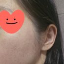 유영식품 | 주사피부염 근황+최종편(병원 졸업 판정을 받았다! 사진 주의)