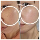 일산 색소레이저 기미 주근깨 없애기 치료 효과 처음인 내돈내산 후기! 일산고운세상피부과