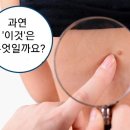 Re:쥐젖 제거 방법 이미지